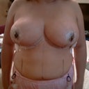4th day you can see the lines where my breasts were hanging before