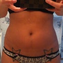 The 17th 3 days after procedure