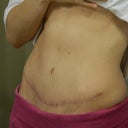 One year post op!