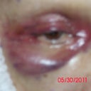 my swollen eye, but no pain