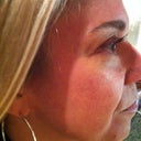 Treatment 1-post Fraxel 7 days, no makeup