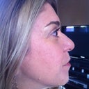 Treatment 1-post Fraxel 8 days, with mineral makeup