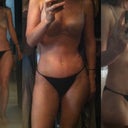 1 week post-op. Umbilical float with diastasis recti repair.