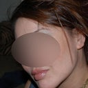 After 5 mm implant - 6 weeks out