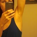 2 days after, very little swelling and slight bruising from lidocaine injections.