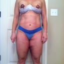 day 3 post op