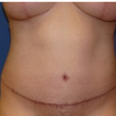 14 weeks post-op