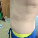 4 months post-op