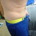 4 months post-op slightly bent over