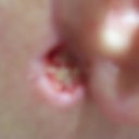 infected hole in front of left ear (after three rounds of antibiotics)
