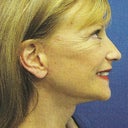 Less waddle but no ear lobes- cannnot wear earring because the piercing is no longer facing forward.