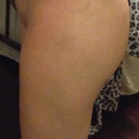 3 weeks post op