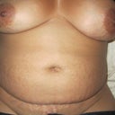close up of stretch marks on belly