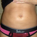 3 weeks post
I can see an improvement but my stomach middle area is still numb and swollen.  Will post more soon