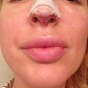 Day 2: Front view nostrils and tip look good so far