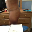 Side view,cant really see a difference here,cuz all the fat,was put at the top middle of my buttocks...