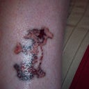 2 weeks after initial treatment.