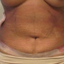 after revision upper abd lipo (11 weeks post TT)