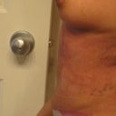 after revision upper abd lipo (11 weeks post TT)