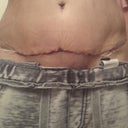 PO day 9, swelling down a bit
