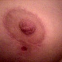 a stitch didnt disolve and i got a little cyst that i took care of for a few days and the hole filled back in. the scar wasnt too bad and i havent had any problems since.
