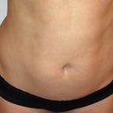 Day of the procedure 1/23/13