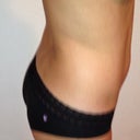 Day of the procedure 1/13/13