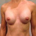 post-op day 10