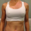 post-op day 10
