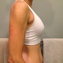 post-op day 10