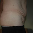 Pre-Op side, standing view. Male. Excess skin after weight loss.
