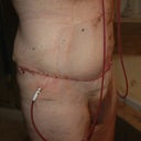 2nd Day Post-Op, side view. Drains still intact. Male extended abdominoplasty with lipo of the suprapubic and epigastric area.
