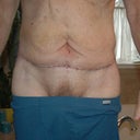 2 weeks Post-Op, front view. Male extended abdominoplasty with lipo of the suprapubic and epigastric area.