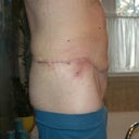 2 weeks Post-Op, side view. Male extended abdominoplasty with lipo of the suprapubic and epigastric area.