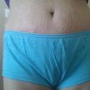 Post op day 6