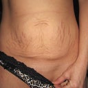 front view of belly- looks worse when I am leaner