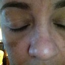 This is the outcome of my fraxel procedures.