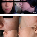 Before the surgery and 8 months after - do not do it. Not worth it.