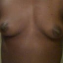 Front view: Before Surgery