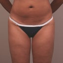 37 Year Old Female Liposuction