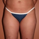 37 Year Old Female Liposuction