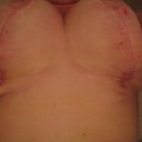 Six weeks. Picture bit dark but shows lollipop scar as apose to anchor/T scar.