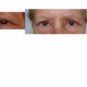 before and day 10