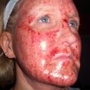 4 hours after deep fx procedure