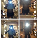Day before and the day after the bodyjet lipo