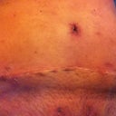 2 wks 5 days PO and BB is still oozy and angry.  New puff below the incision materialized this morning after binder came off for a little while.