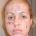 Right after the procedure- pinpoint bleeding, swelling