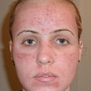 Day 1- swelling, redness, mild oozing