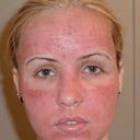 Day 2- swelling and redness