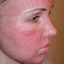 Day 3- swelling and redness
